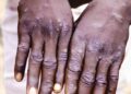 Isifo sokhwekhwe iMpox sele sisube umphefumlo eRhawutini.