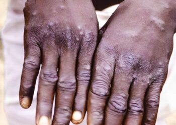 Isifo sokhwekhwe iMpox sele sisube umphefumlo eRhawutini.