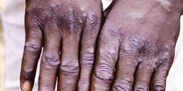 Isifo sokhwekhwe iMpox sele sisube umphefumlo eRhawutini.